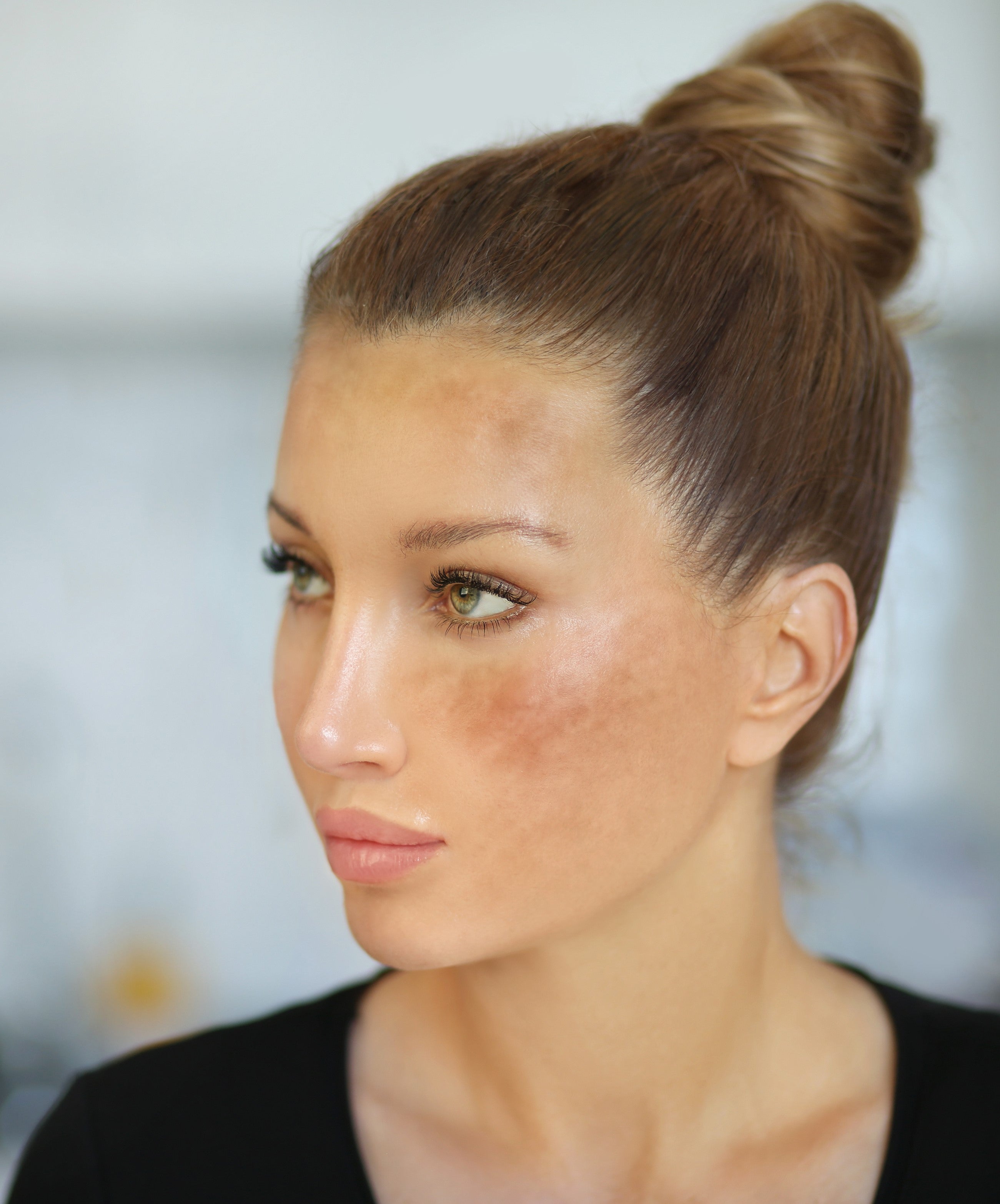 Photo of lady with Melasma