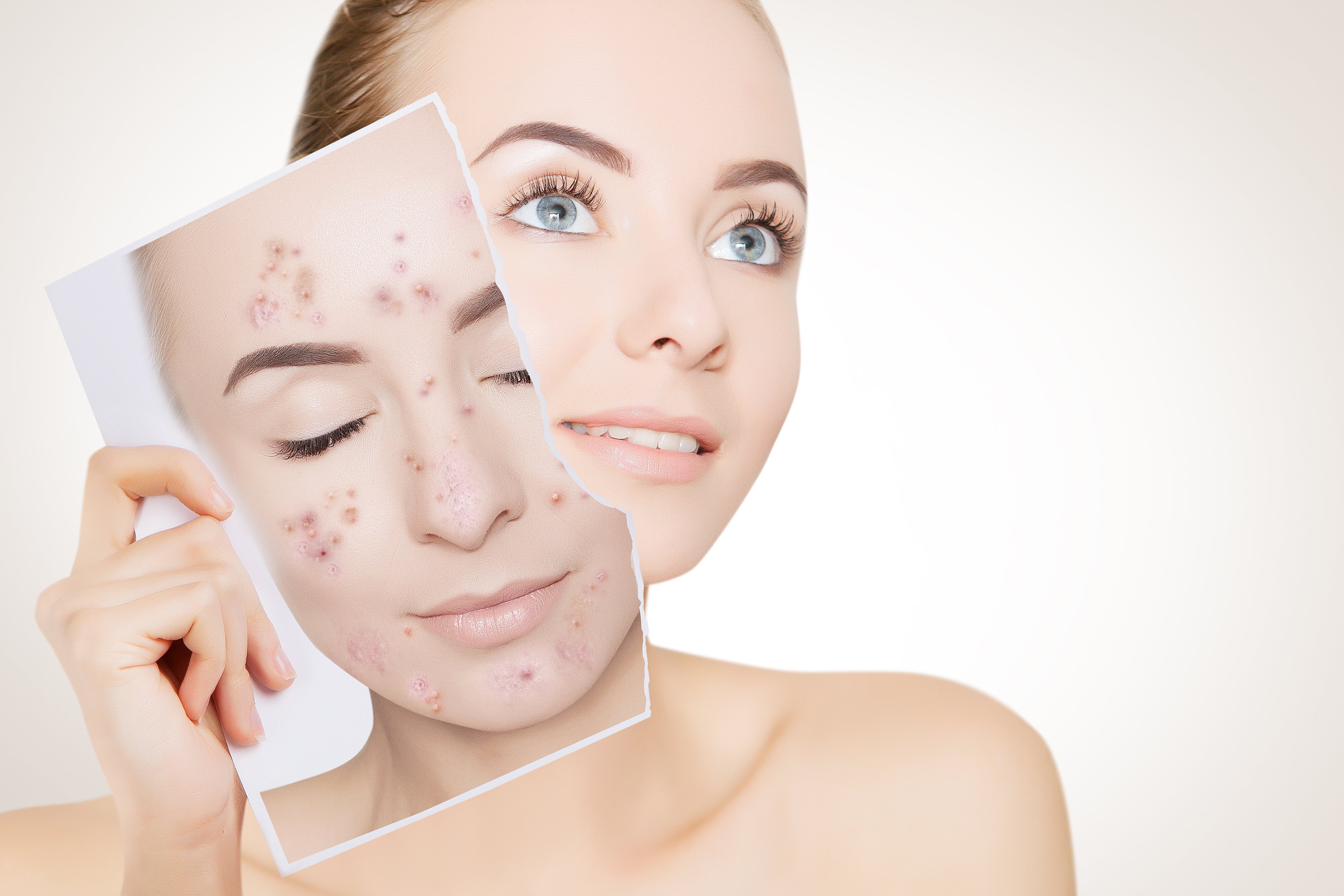 Acne & Melasma