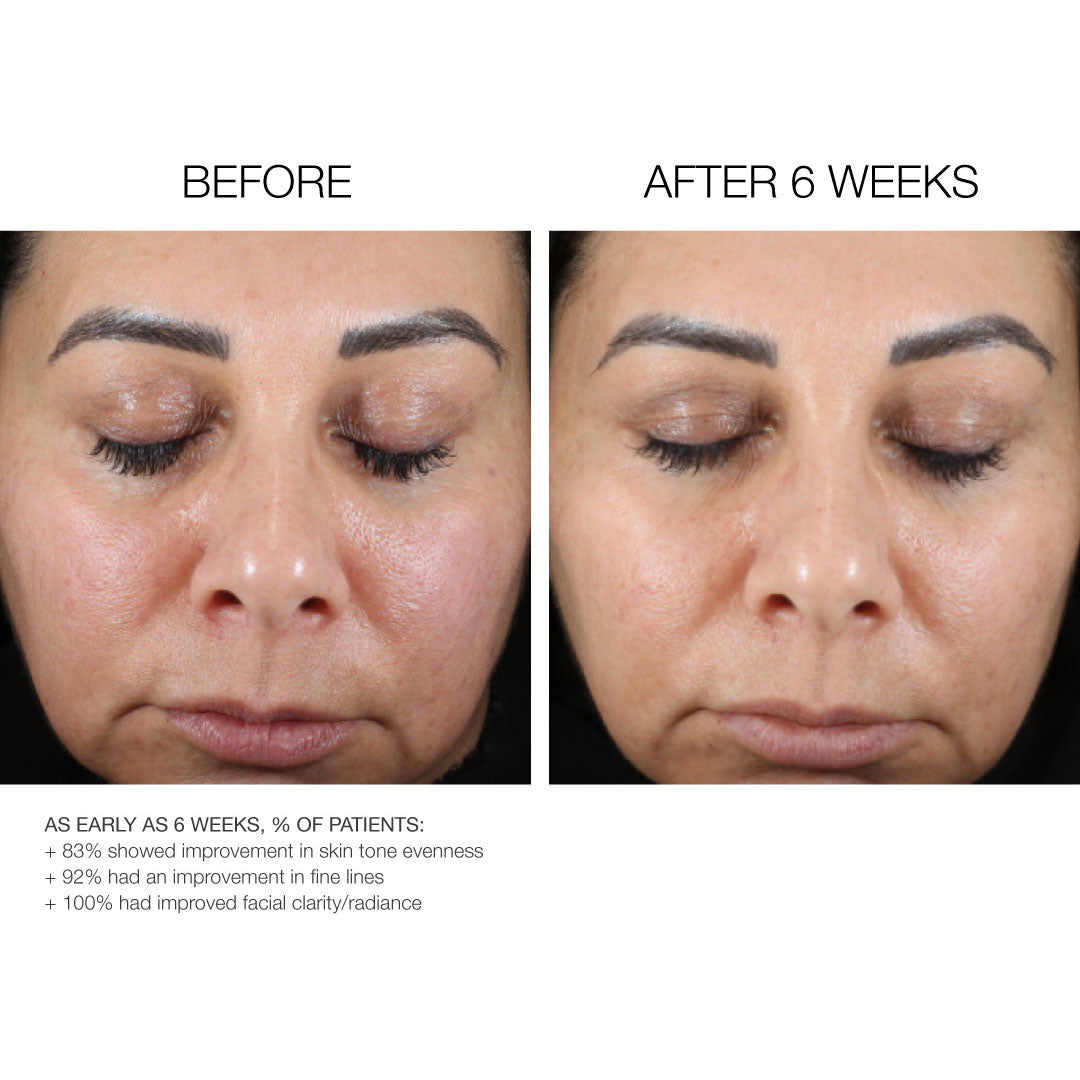 Fine Line Reduction .1%