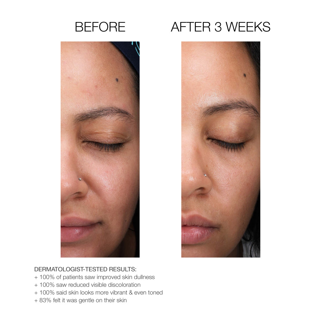 Gentle Exfoliating Serum Before and after photos