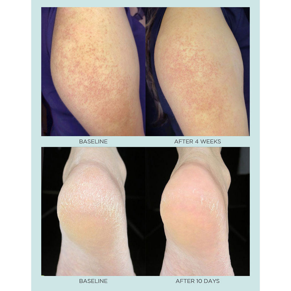 Heels + Elbows before and after photos