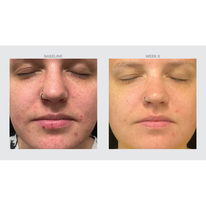 Oil + Inflammation Control before and after photos