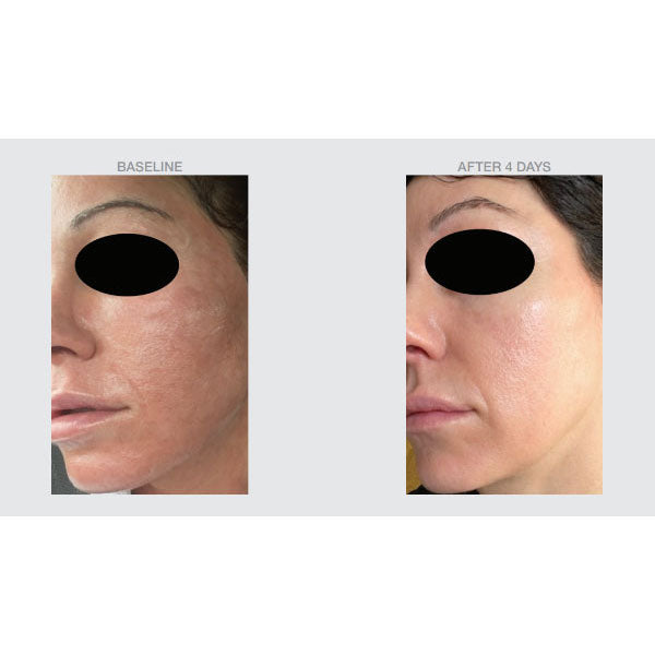 PIE Reducing Serum before and after photos