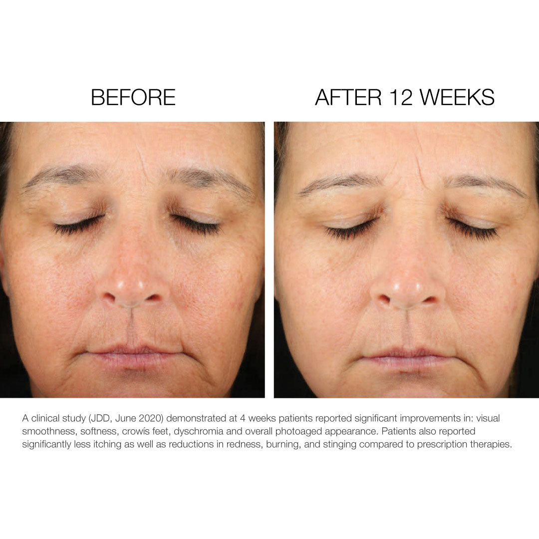 Deep Wrinkle Reduction 1% before and after photo