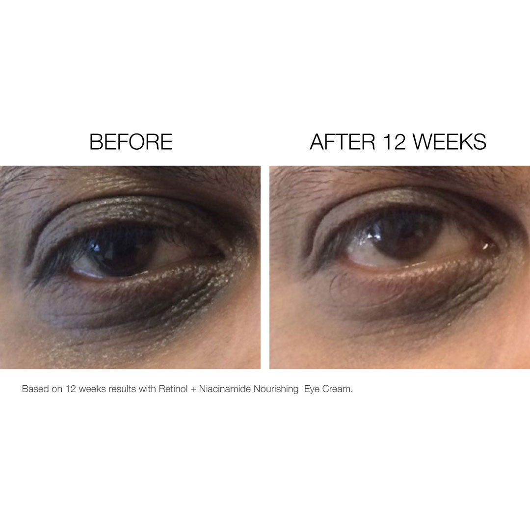 Eye Creme + Retinol before and after photo