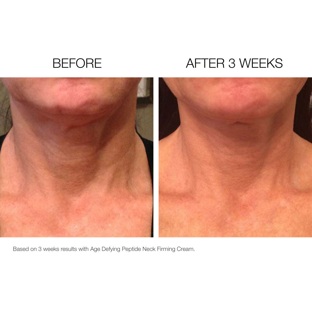 Neck + Dec before and after photos